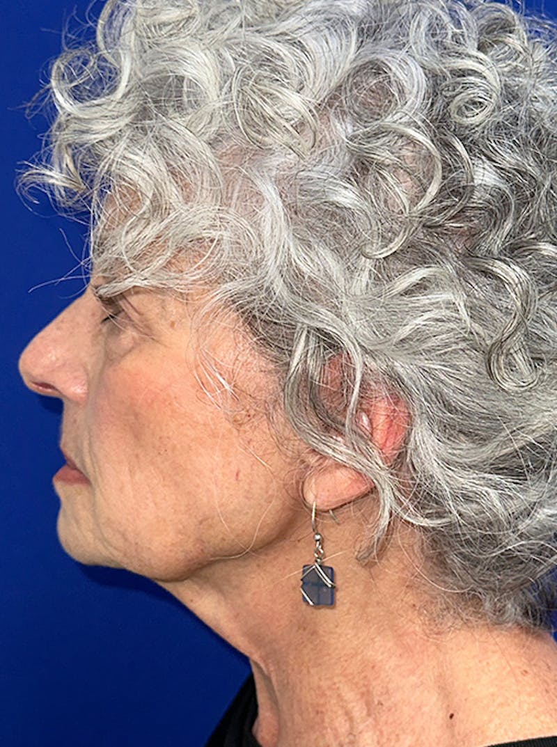 Neck Lift Before & After Gallery - Patient 187551 - Image 9