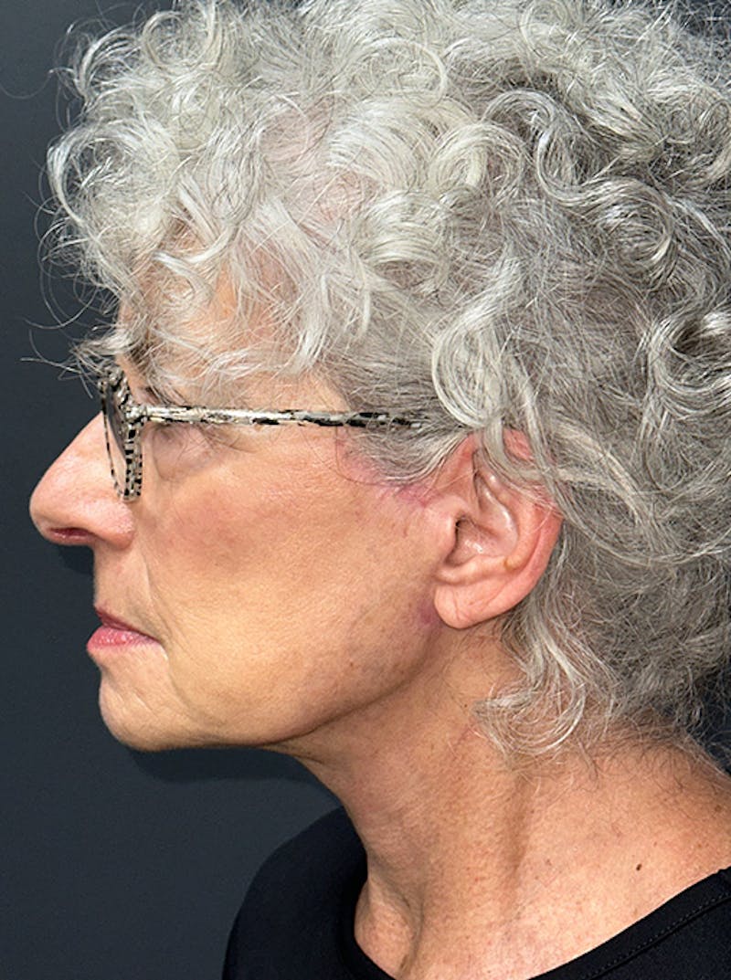 Neck Lift Before & After Gallery - Patient 187551 - Image 10