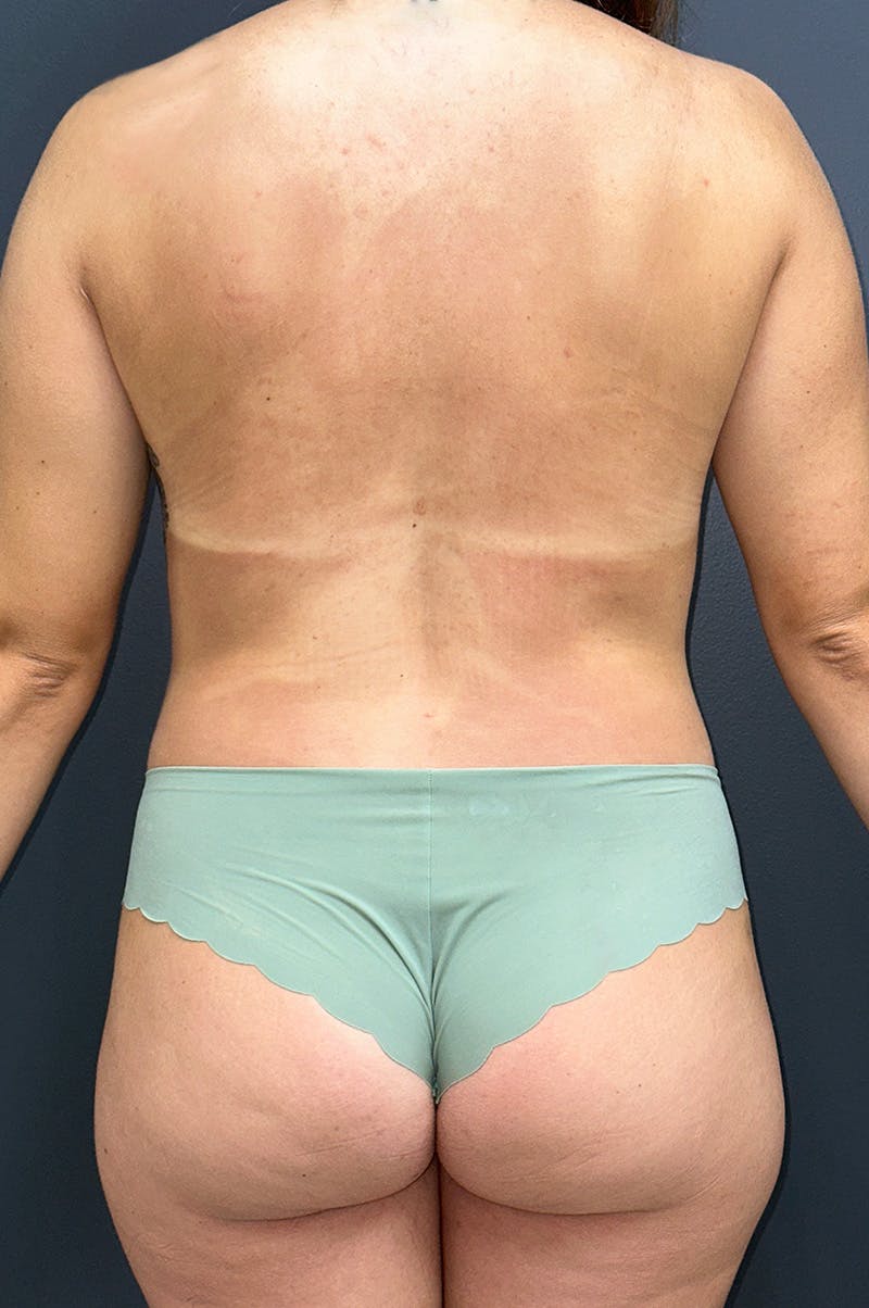 Liposuction Before & After Gallery - Patient 155267 - Image 4