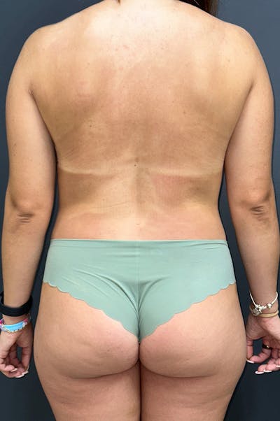 Liposuction Before & After Gallery - Patient 155267 - Image 2
