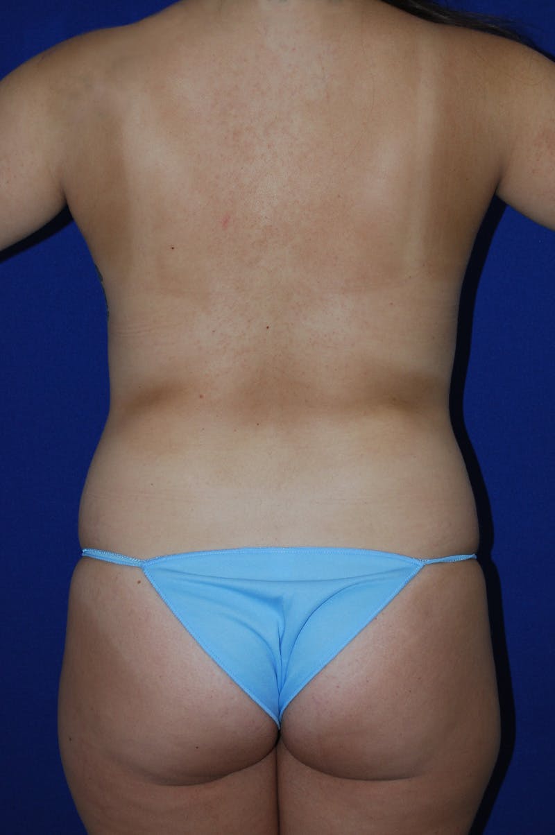Liposuction Before & After Gallery - Patient 155267 - Image 3