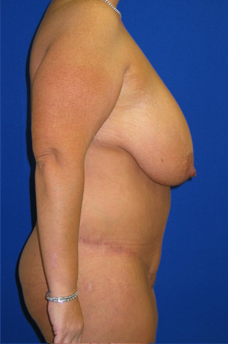 Circumferential Body Lift Before & After Gallery - Patient 856890 - Image 8