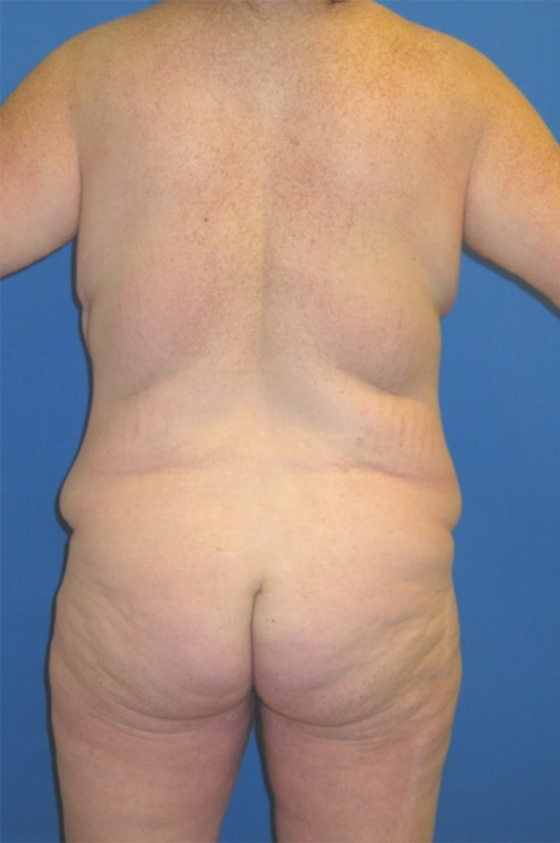 Circumferential Body Lift Before & After Gallery - Patient 856890 - Image 3
