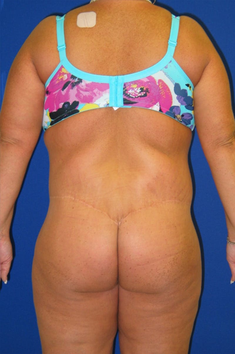 Circumferential Body Lift Before & After Gallery - Patient 856890 - Image 4