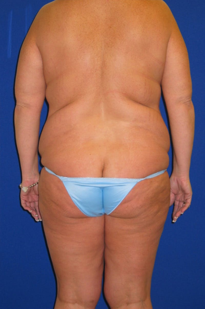 Circumferential Body Lift Before & After Gallery - Patient 856890 - Image 5