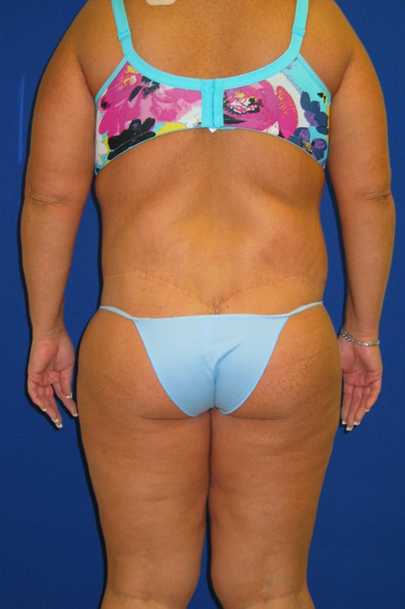 Circumferential Body Lift Before & After Gallery - Patient 856890 - Image 6