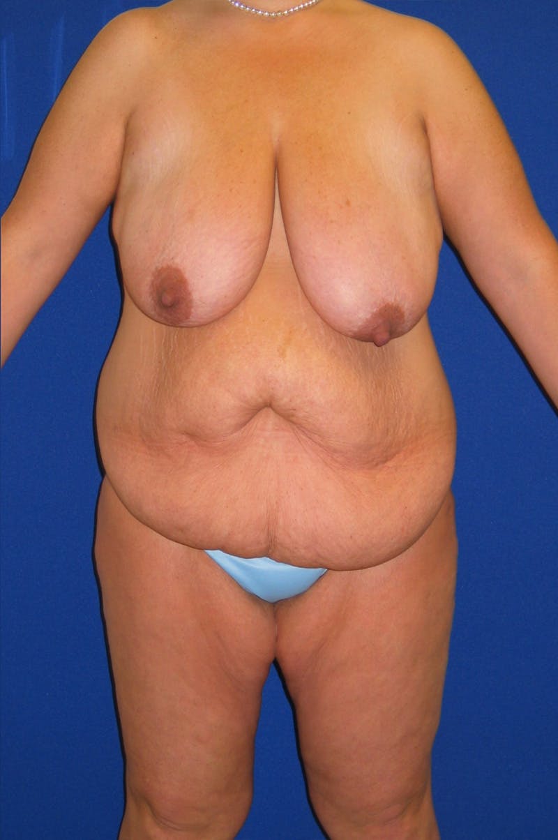 Circumferential Body Lift Before & After Gallery - Patient 856890 - Image 1