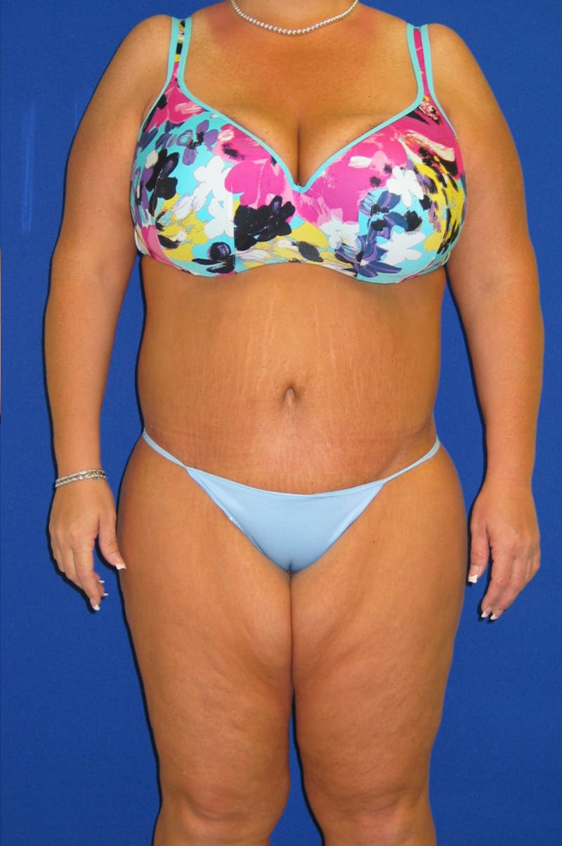 Circumferential Body Lift Before & After Gallery - Patient 856890 - Image 2