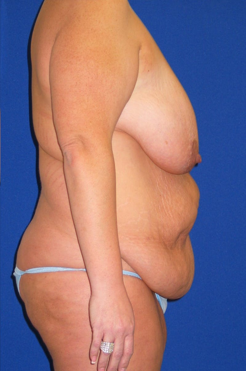 Circumferential Body Lift Before & After Gallery - Patient 856890 - Image 7