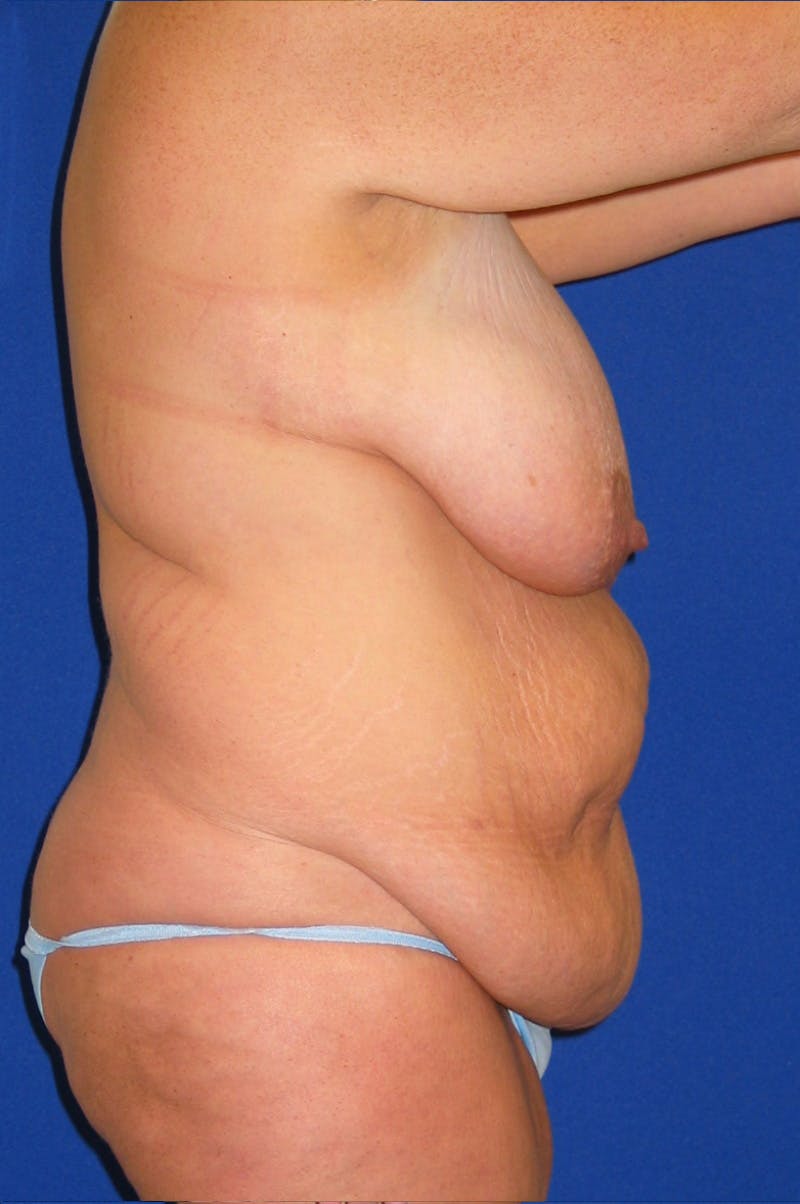 Circumferential Body Lift Before & After Gallery - Patient 856890 - Image 9