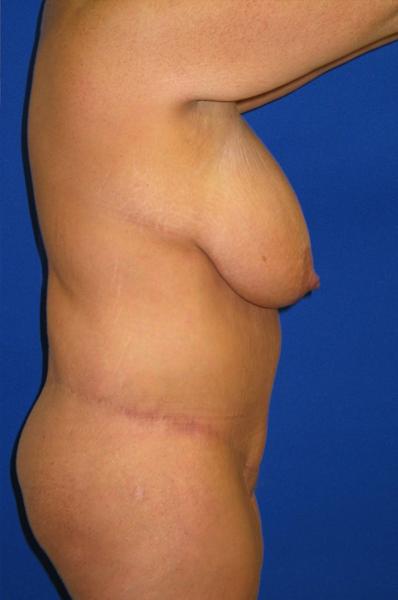 Circumferential Body Lift Before & After Gallery - Patient 856890 - Image 10