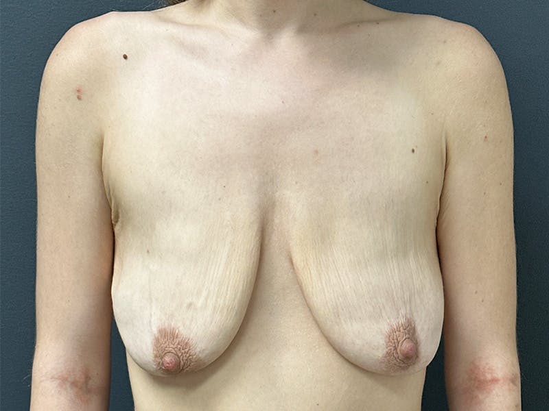 Breast Before & After Gallery - Patient 288445 - Image 1