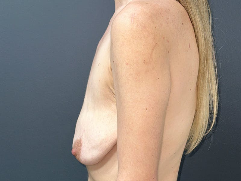 Breast Before & After Gallery - Patient 288445 - Image 5