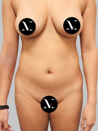 Liposuction Before & After Gallery - Patient 187998029 - Image 1