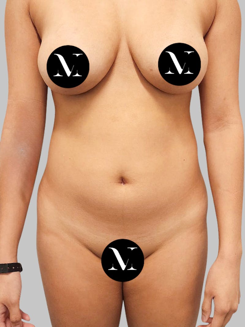 Liposuction Before & After Gallery - Patient 187998029 - Image 1