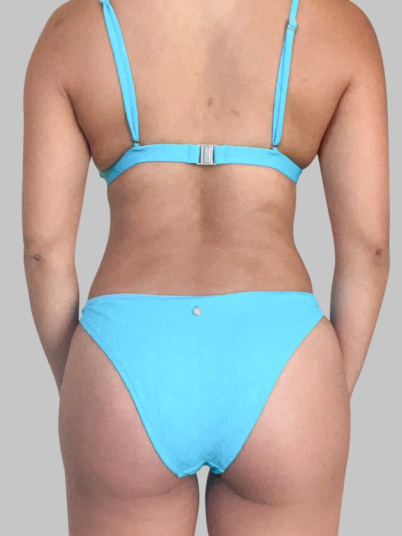 Liposuction Before & After Gallery - Patient 187998029 - Image 8