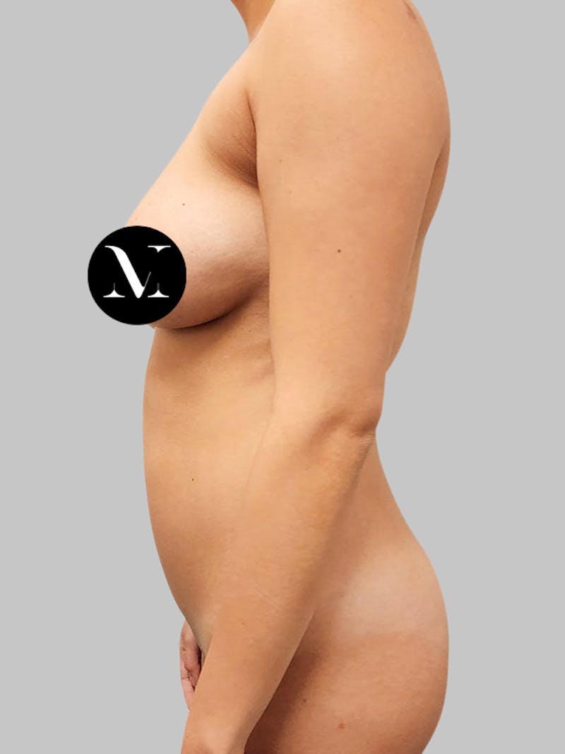 Liposuction Before & After Gallery - Patient 187998029 - Image 5