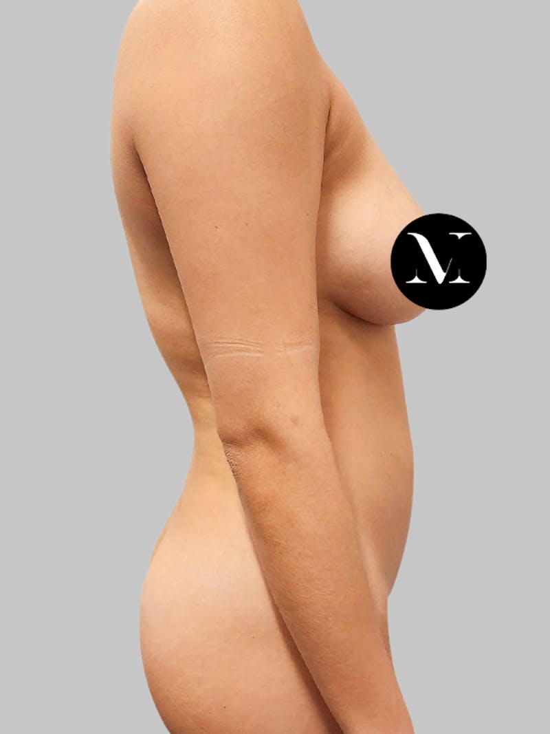 Liposuction Before & After Gallery - Patient 187998029 - Image 3