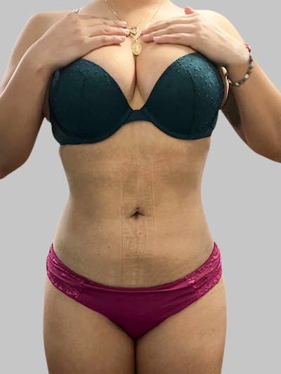 Liposuction Before & After Gallery - Patient 187998030 - Image 2