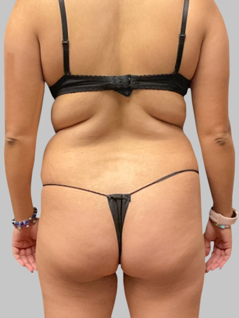 Liposuction Before & After Gallery - Patient 187998030 - Image 3