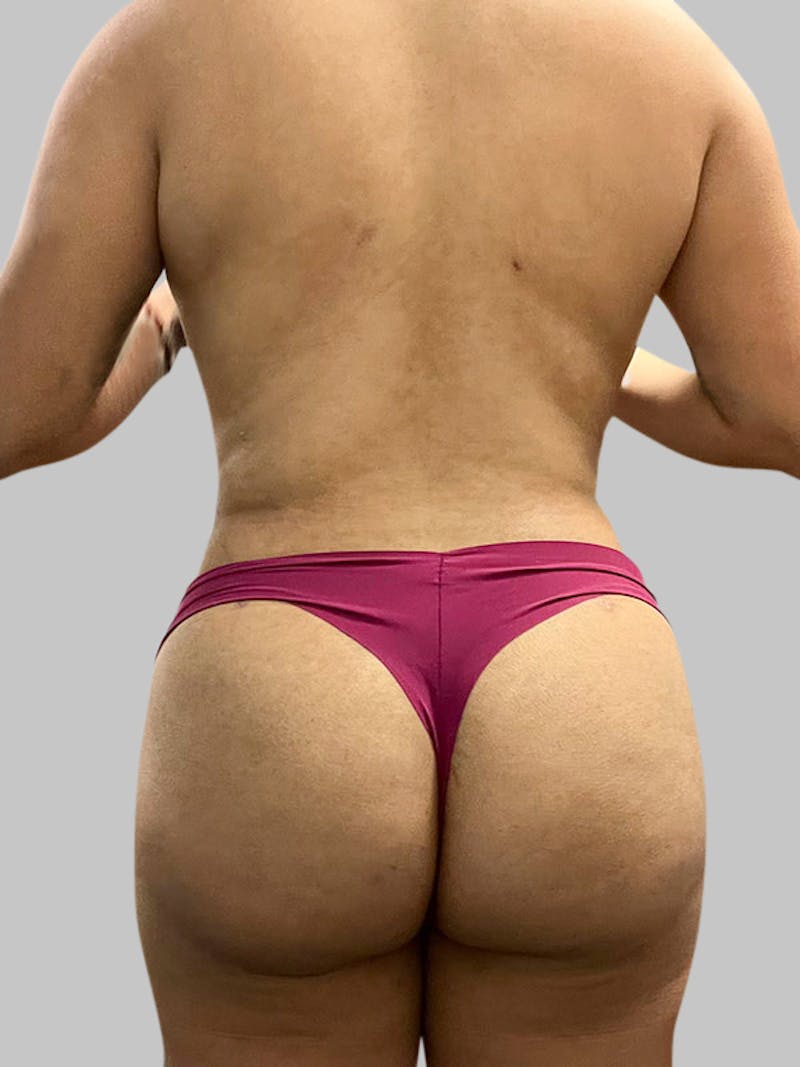 Liposuction Before & After Gallery - Patient 187998030 - Image 4