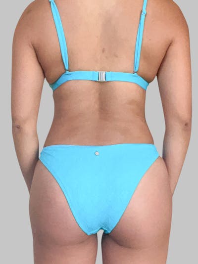 Brazilian Butt Lift Patient 188003904 After Back