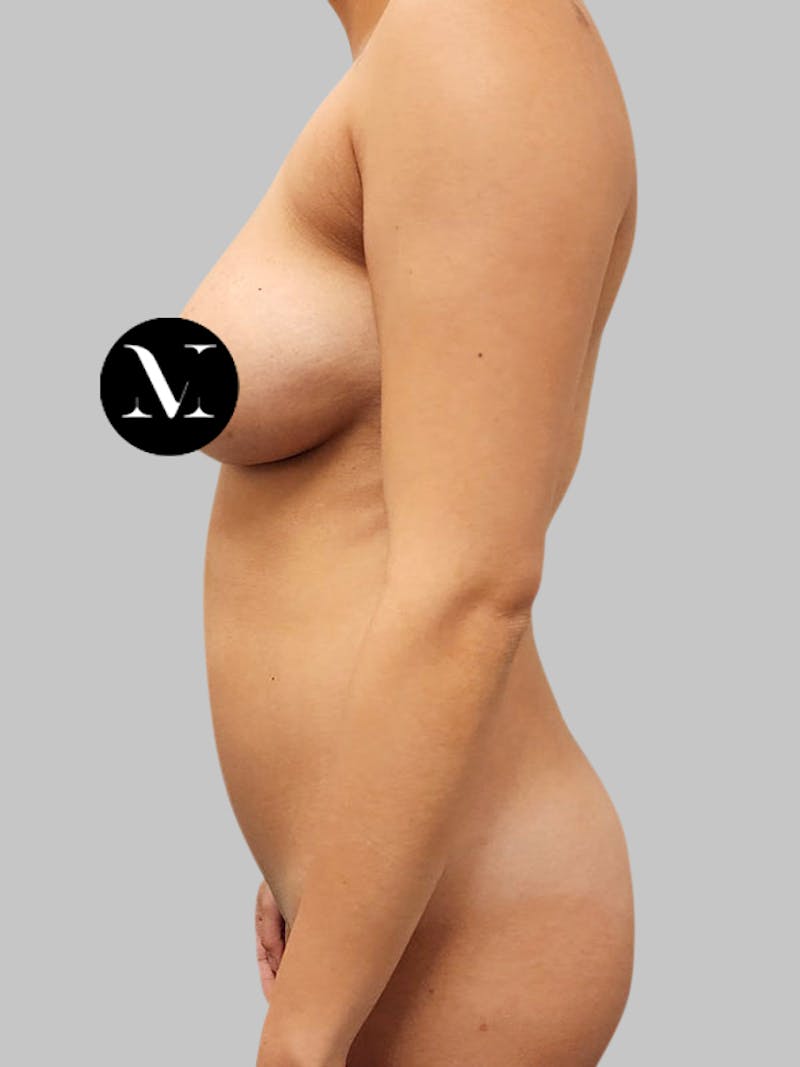 Brazilian Butt Lift Patient 188003904 Before Left Side