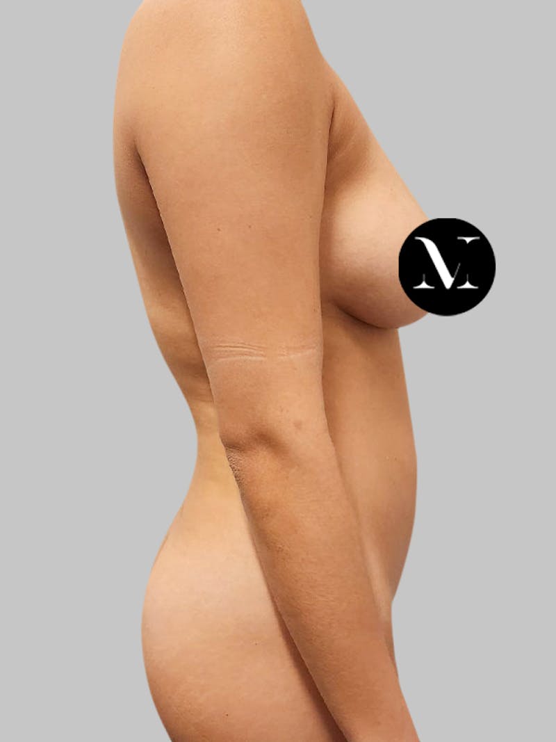 Brazilian Butt Lift Patient 188003904 Before Right Side