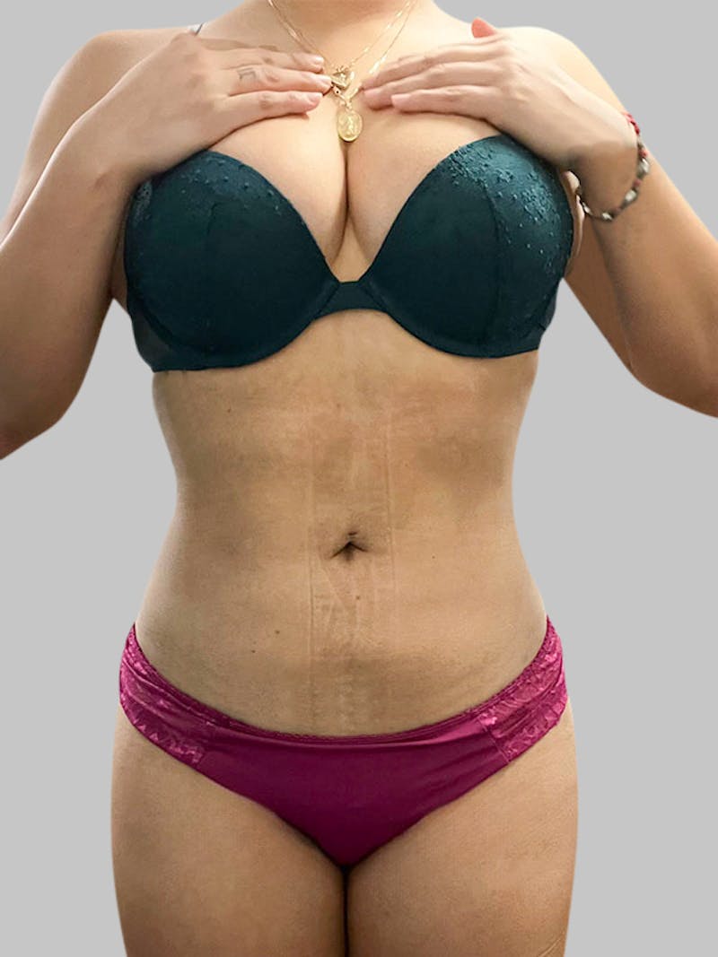 Brazilian Butt Lift Patient 188003905 After Front