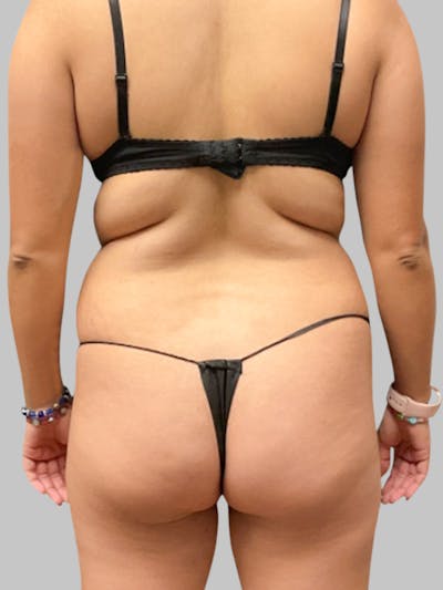 Brazilian Butt Lift Patient 188003905 Before Back