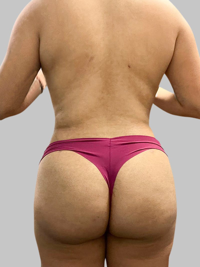 Brazilian Butt Lift Patient 188003905 After Back
