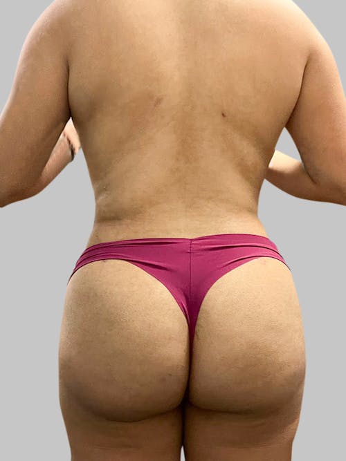Brazilian Butt Lift Patient 188003905 After Back