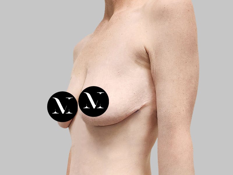 Breast Augmentation-Mastopexy Before & After Gallery - Patient 310431 - Image 3