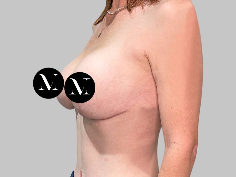 Breast Augmentation-Mastopexy Before & After Gallery - Patient 310431 - Image 4