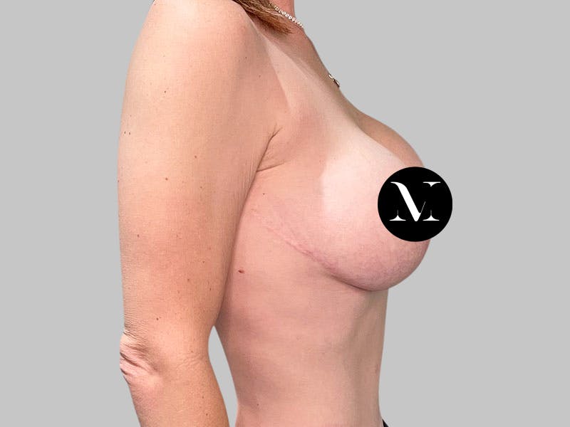 Breast Augmentation-Mastopexy Before & After Gallery - Patient 310431 - Image 5