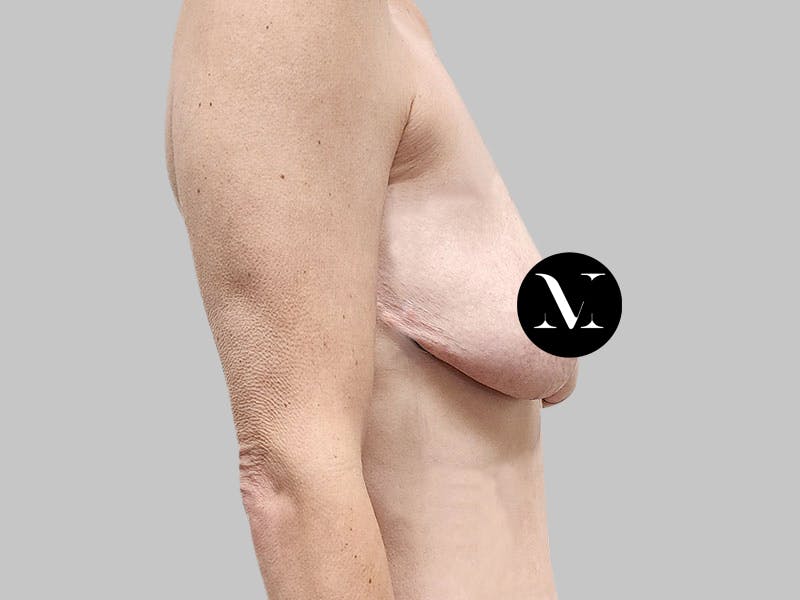 Breast Augmentation-Mastopexy Before & After Gallery - Patient 310431 - Image 6