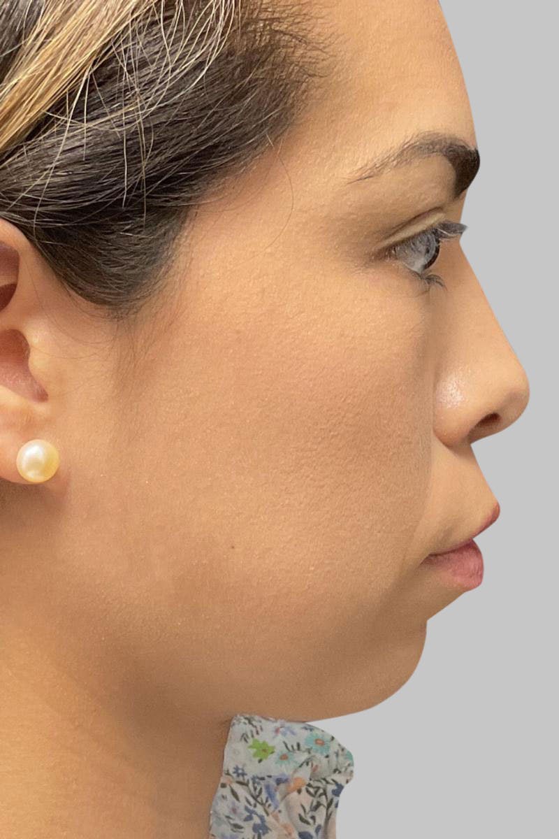 Injectables Before & After Gallery - Patient 187993666 - Image 3