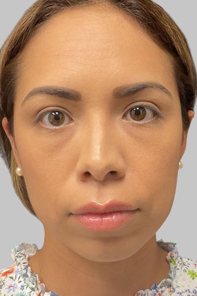 Injectables Before & After Gallery - Patient 187993666 - Image 1
