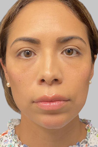 Injectables Before & After Gallery - Patient 187993666 - Image 2