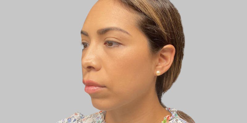 Injectables Before & After Gallery - Patient 187993666 - Image 5