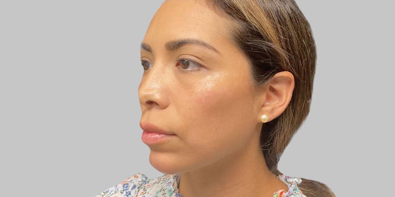 Injectables Before & After Gallery - Patient 187993666 - Image 6
