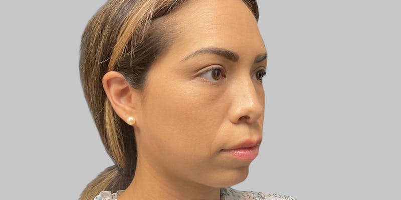 Injectables Before & After Gallery - Patient 187993666 - Image 7
