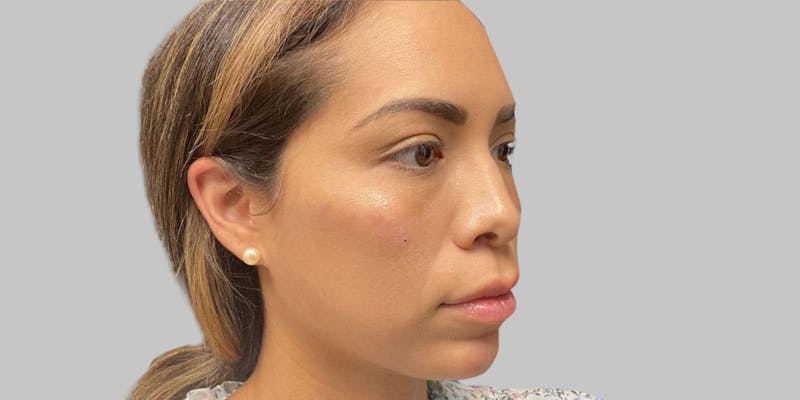 Injectables Before & After Gallery - Patient 187993666 - Image 8