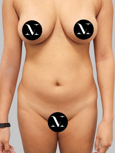 Renuvion Skin Tightening Before & After Gallery - Patient 187994316 - Image 1