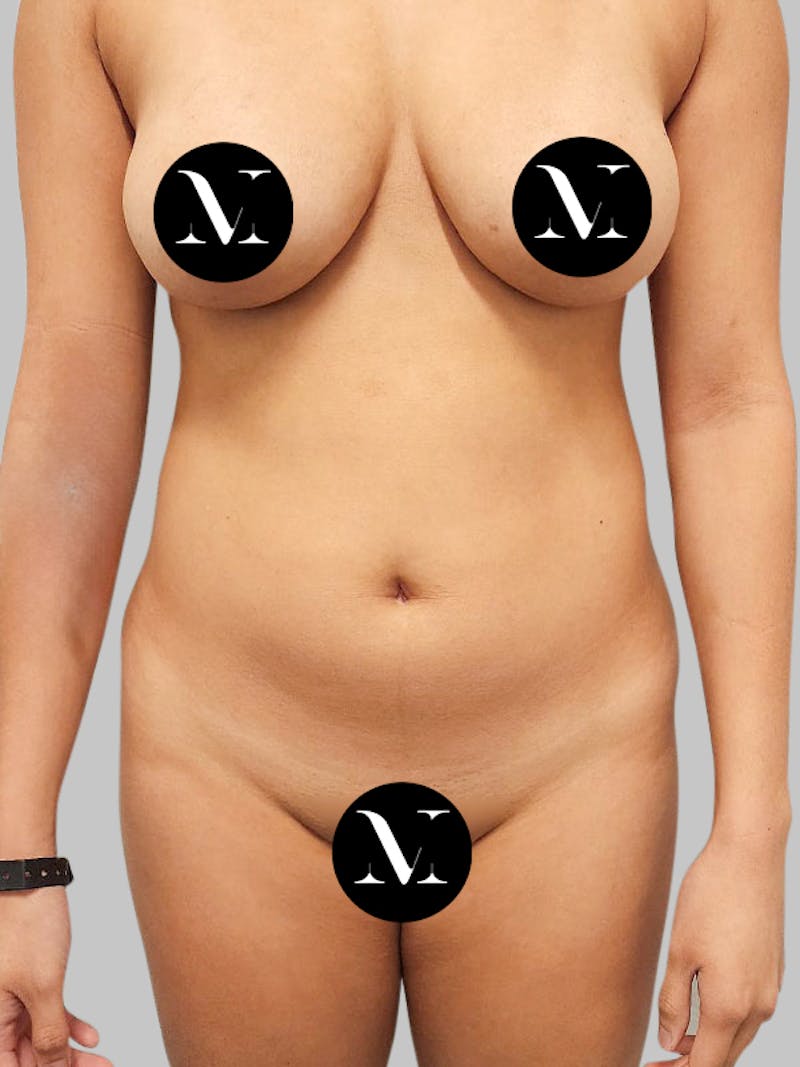 Renuvion Skin Tightening Before & After Gallery - Patient 187994316 - Image 1