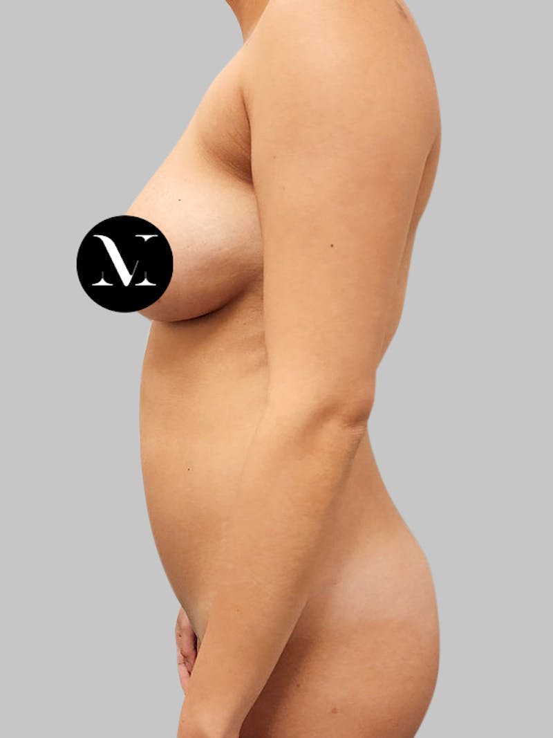 Renuvion Skin Tightening Before & After Gallery - Patient 187994316 - Image 5