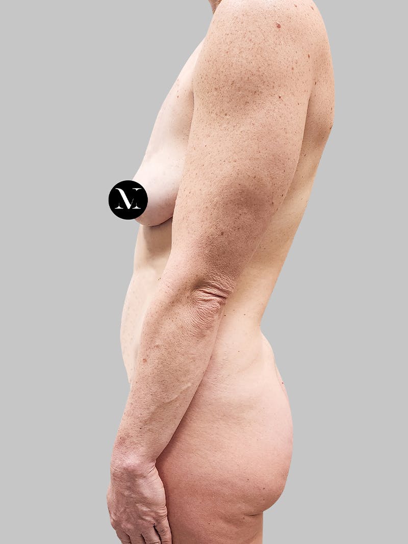 Tummy Tuck Patient 187993363 Before Left Side