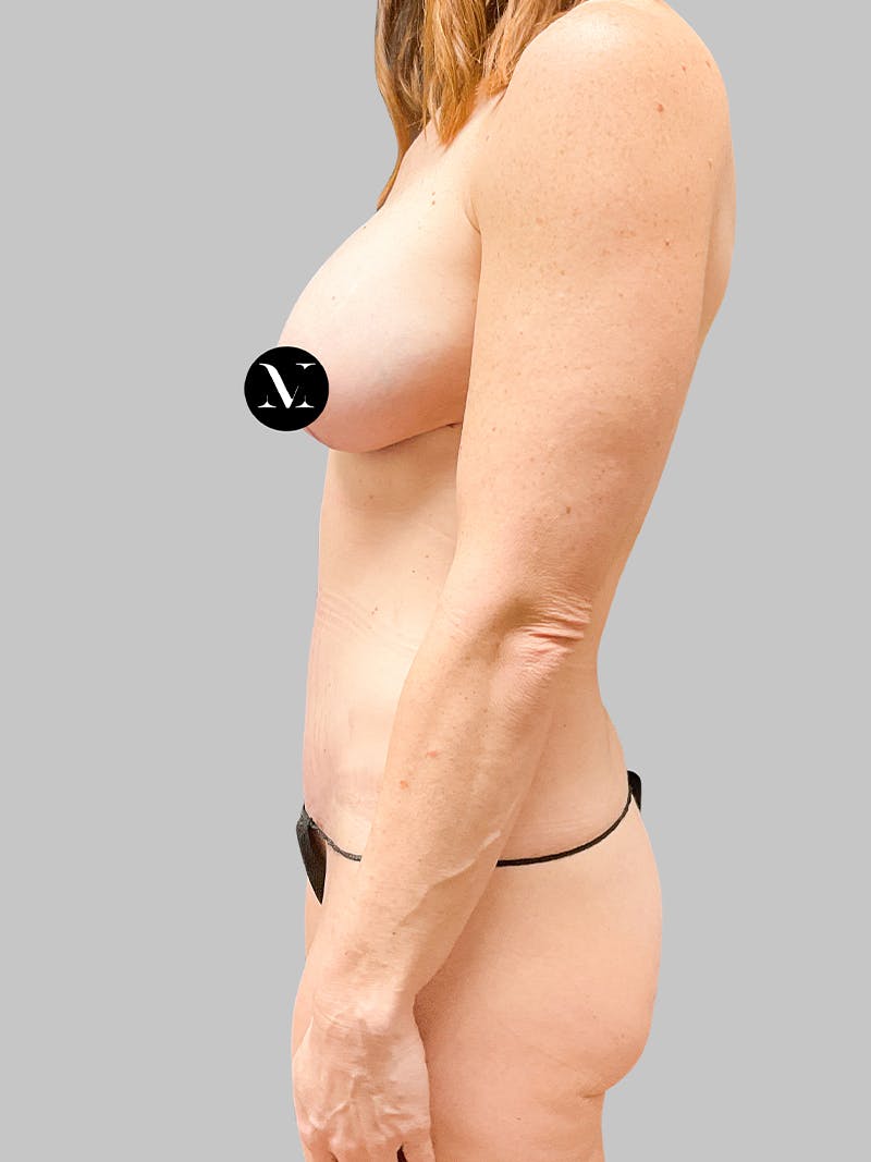 Tummy Tuck Patient 187993363 After Left Side