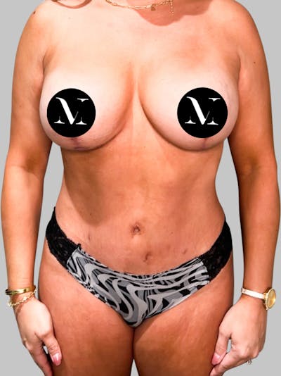 Tummy Tuck Patient 187993366 After Front