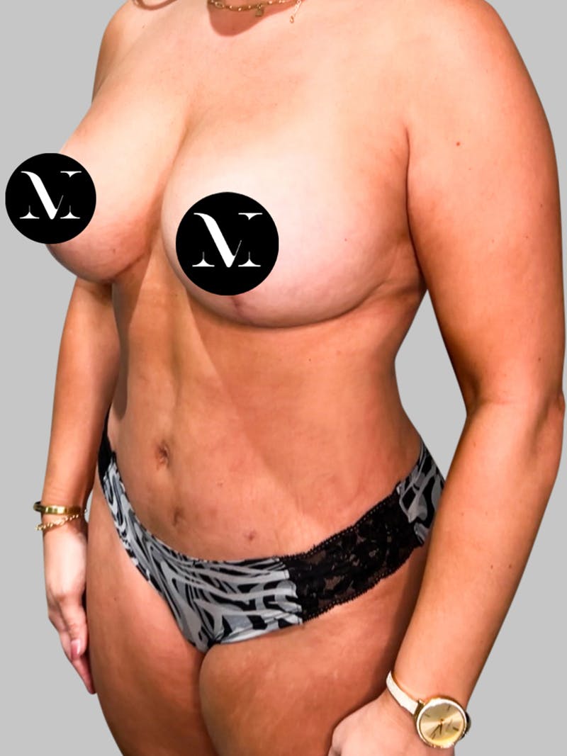 Tummy Tuck Patient 187993366 After Left Angle